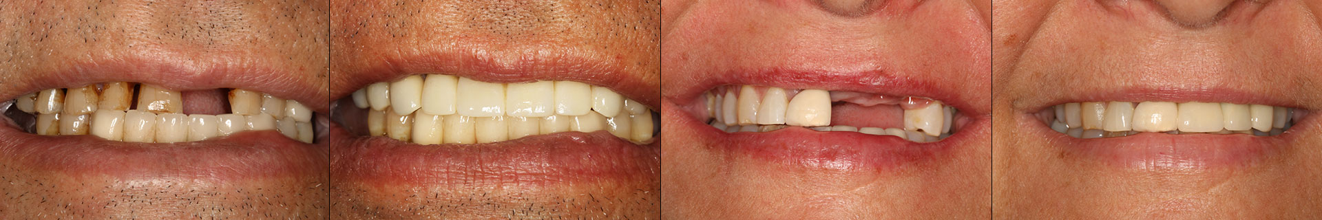 All on Four Dental Implants in Pembroke Pines, FL, Before and After
