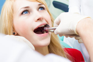 Tooth extraction cooper city