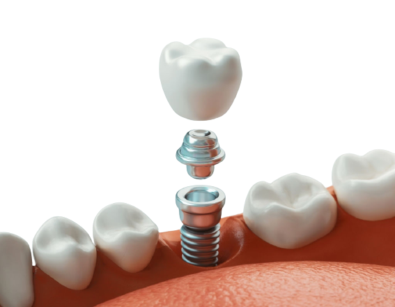 Dental Implants Pembroke Pines FL